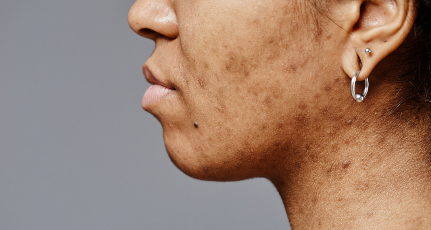How Food Sensitivity Testing Can Fix Your Acne