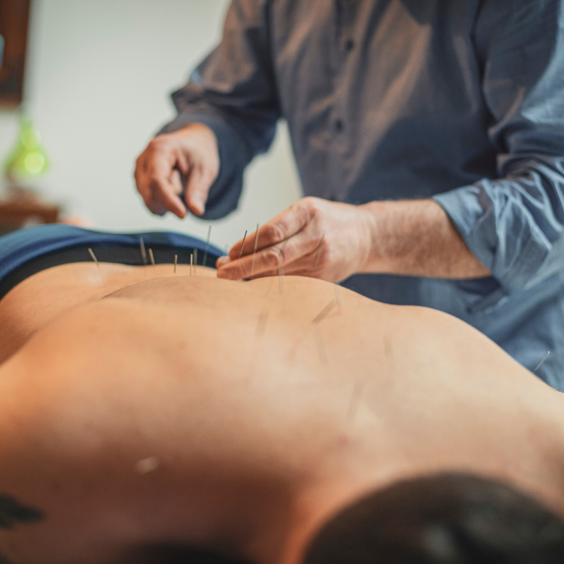 Person receiving acupuncture with needles on their back.